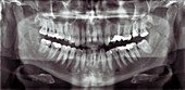 Panoramic dental X-ray