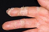 Exfoliative dermatitis on the hand