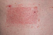 Allergy to drug patches on chest