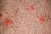 Mosquito bites on the leg