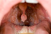 Congenital abnormality of the uvula