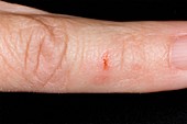 Mouse bite on the finger