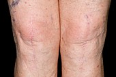 Total knee replacement scars