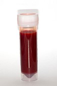 Blood-stained knee joint fluid