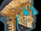 Normal head,cone beam CT scan