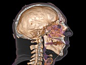 Normal head,3D CT scan