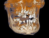 Cleidocranial dysplasia,3D CT scan