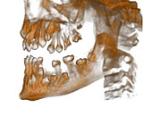 Cleidocranial dysplasia,3D CT scan