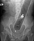 Vibrator in man's rectum,X-ray