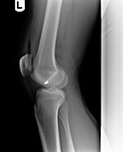 Firearm injury,X-ray