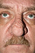 Rhinophyma of the nose