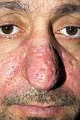 Rhinophyma of the nose