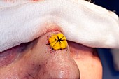 Basal cell carcinoma surgery