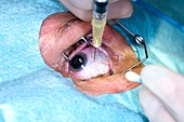 Treatment for macular degeneration
