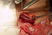 Bowel cancer surgery