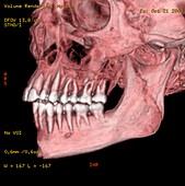 Broken chin,3D CT scan