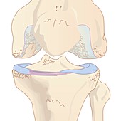 Osteoarthritis of the knee,artwork