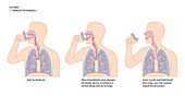 Asthma inhaler use,artwork