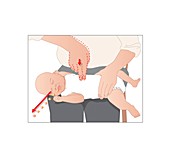 Choking first aid,artwork