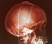 Deep brain stimulation electrodes,X-ray