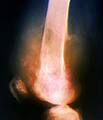 Bone cancer in the femur,X-ray