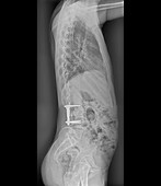 Pinned backbone,X-ray
