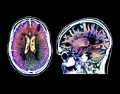 Pyramidal brain syndrome,MRI scans