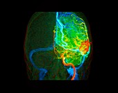 Arteriovenous malformation,3D angiogram