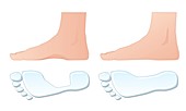 Flat foot comparison,artwork