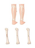 Types of fracture,artwork