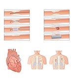 Heart disease treatment,artwork