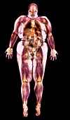 Obese woman,MRI scan