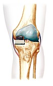 Partial knee replacement,artwork