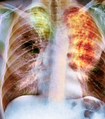 Old and new tuberculosis,X-ray