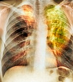 Old and new tuberculosis,X-ray