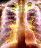 Bullous emphysema,X-ray