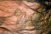 Seborheic eczema on the scalp