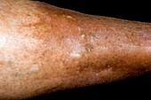 Varicose eczema of the leg
