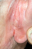 Eczema behind the ear