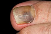 Fungal infection of the toenail