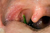 Foreign body stuck on a tonsil