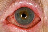 Eye irritation after trabeculectomy