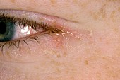 Herpes simplex infection of the eye