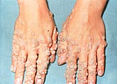 Common warts