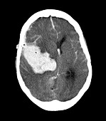 Subarachnoid haemorrhage,MRI scan
