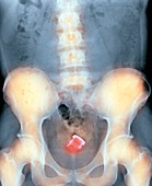 Drinks bottle in man's rectum,X-ray