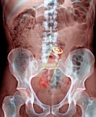 Deodorant can in man's rectum,X-ray