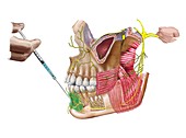 Dental anaesthesia,artwork