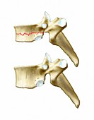 Compression fracture,artwork