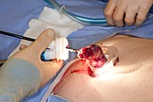 Gallbladder removal surgery